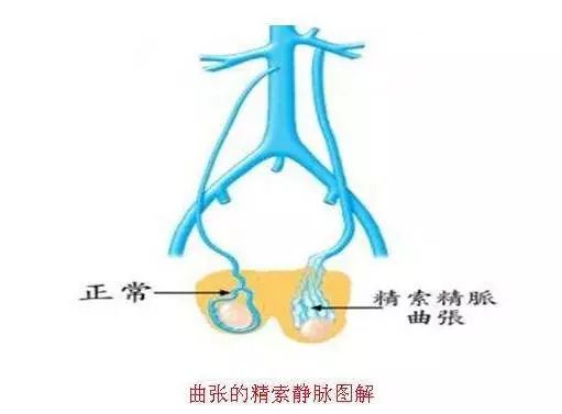男性得了精索静脉曲张会不育吗?