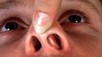 你了解鼻部乳头状瘤吗?