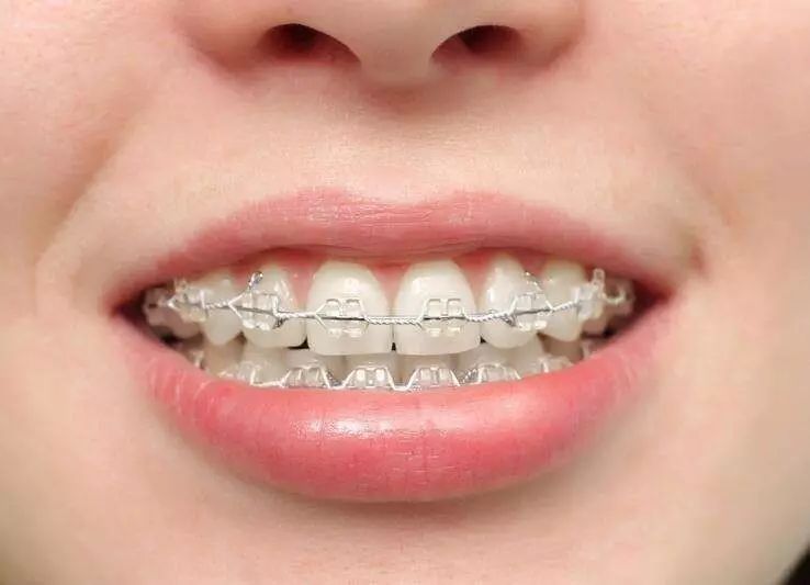 牙齿固定矫正需要注意些什么?