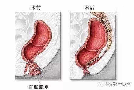 肛门异物就是痔疮?有可能是其它肛肠疾病!