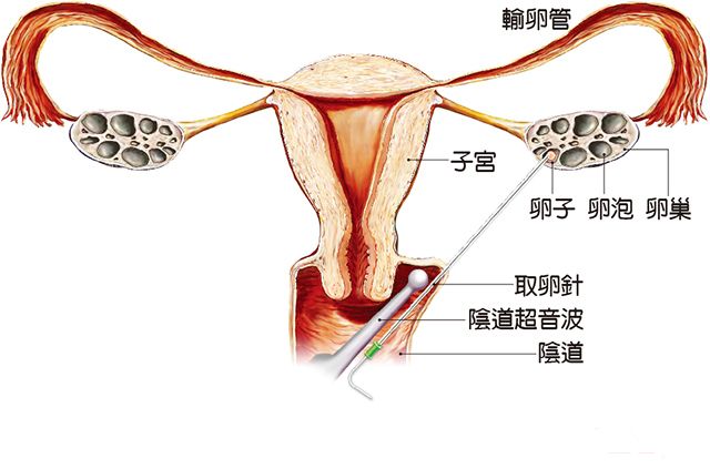 试管婴儿取卵.jpg