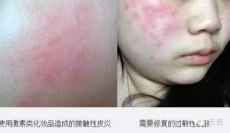 都知道皮肤发红是面部皮肤过敏常见的症状之一.