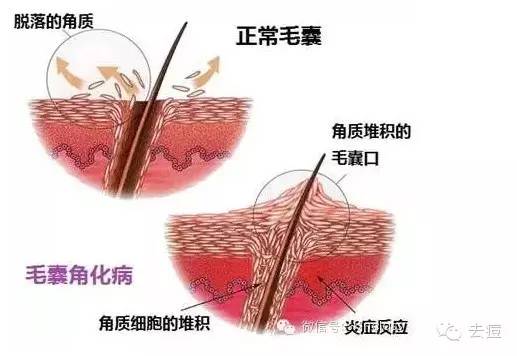 什么是毛囊角化症,要怎么护理?