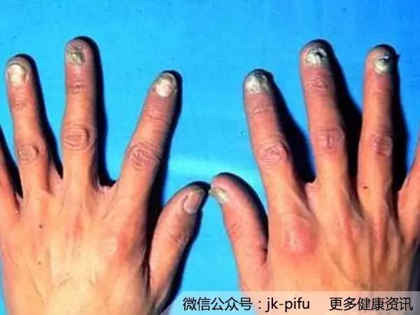 得了灰指甲,去医院该挂什么科?