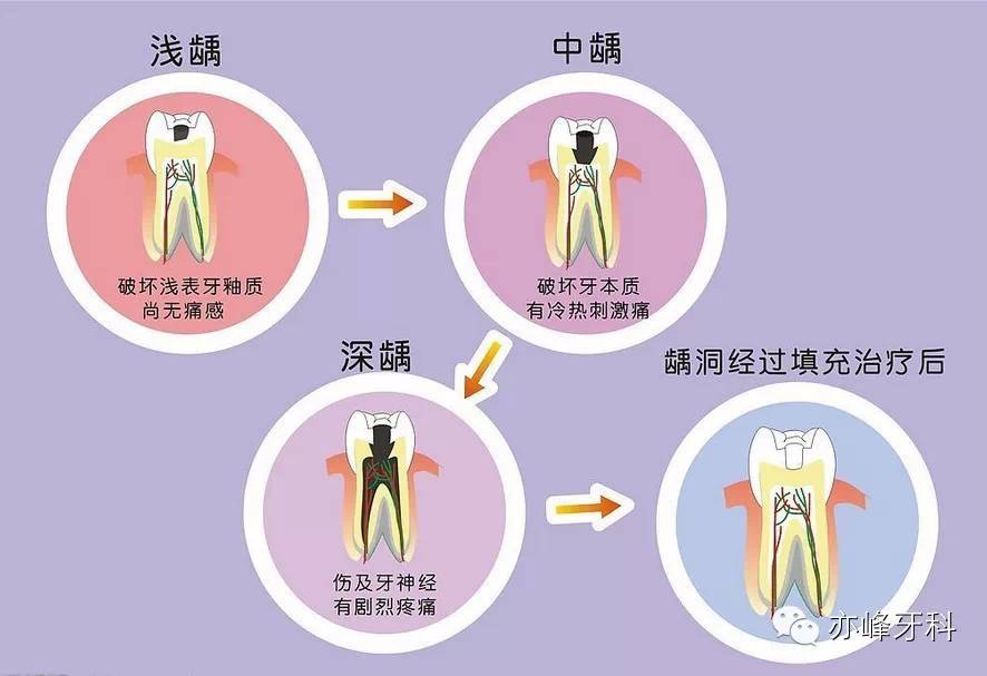 小"龋病",大危害,严重可致牙齿缺失!