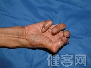 11,肌肉萎缩