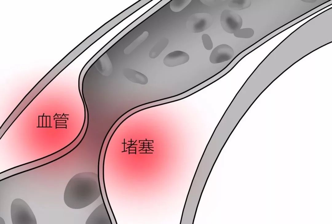 每天走路预防和缓解哪些疾病?