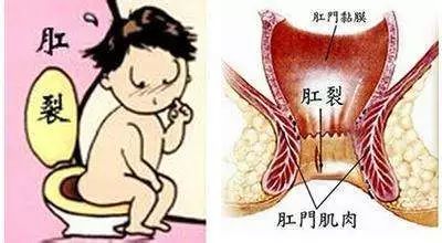 肛裂保守治疗知多少