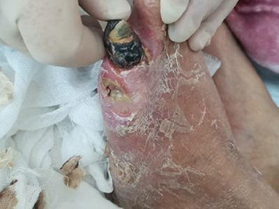 jpg Ⅳ级糖尿病足脚趾坏死发黑脱皮图.jpg