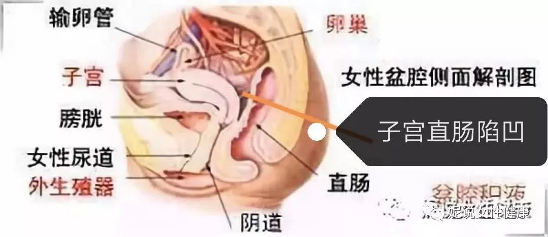 盆腔积液是怎么回事?是盆腔炎吗?