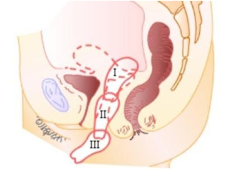 子宮脫垂高清的圖片