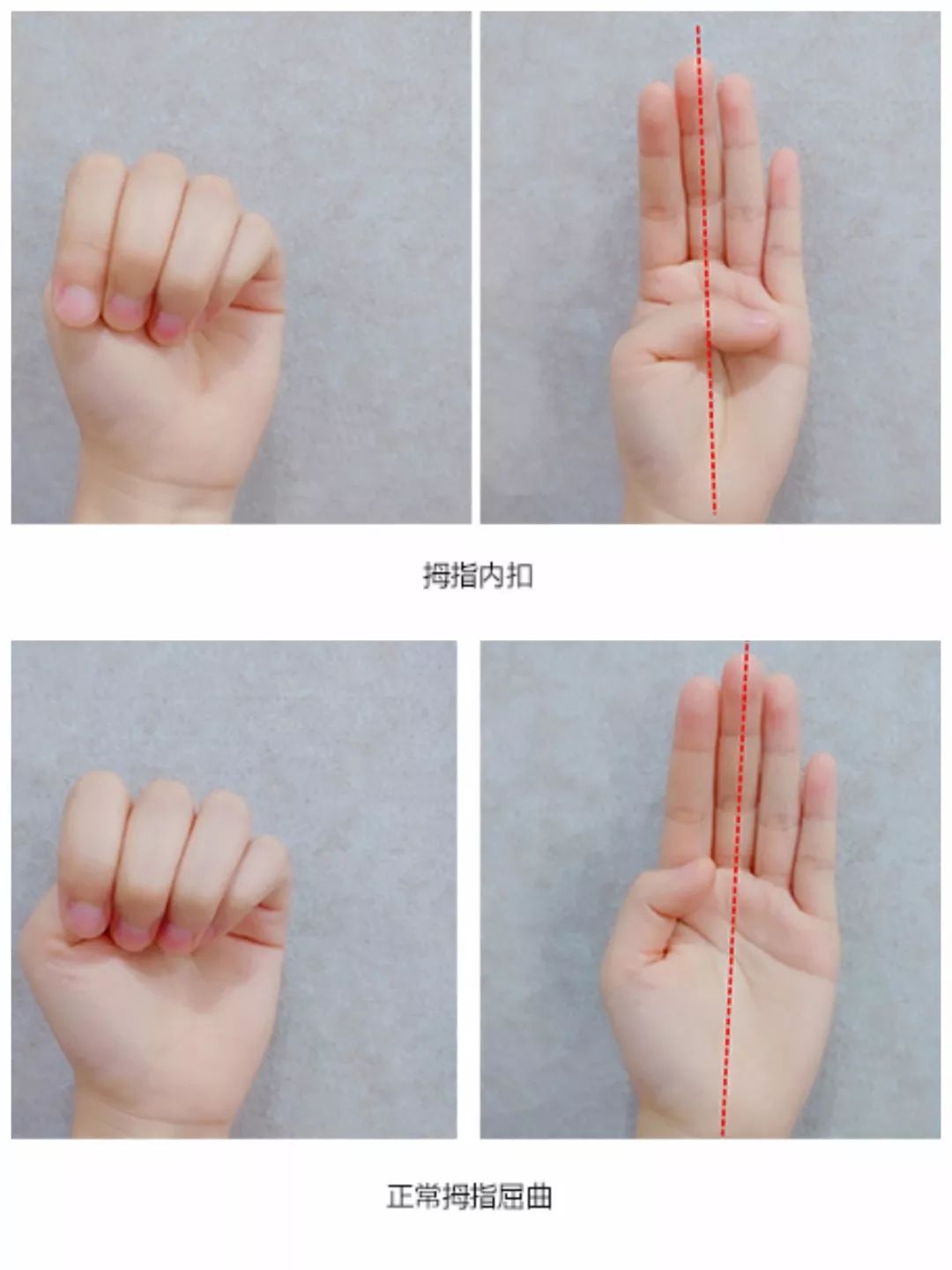 网上说拇指内扣可能是脑瘫,为什么又有人说拇指内扣是正常呢?