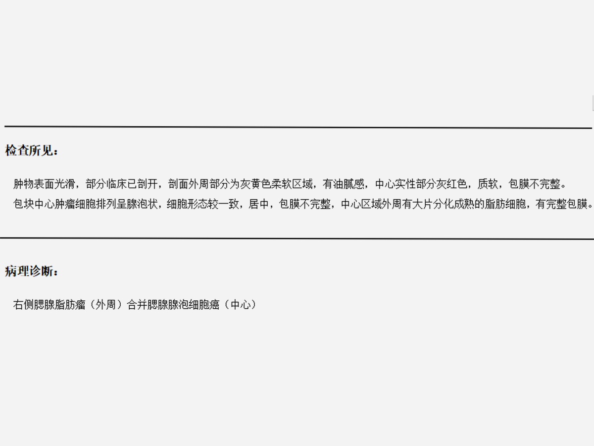 腺泡細胞癌（64歲老人患腮腺腺泡細胞癌，耳下腫物要規(guī)范就醫(yī)！）.jpg