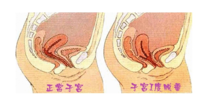 子宮脫垂12度的圖片