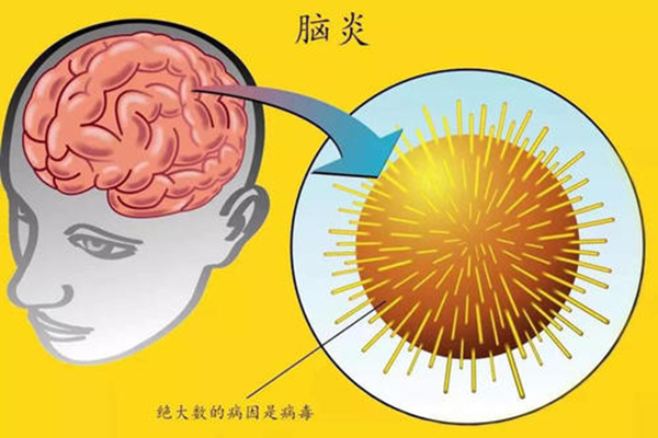 病毒脑炎.jpg