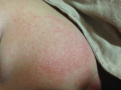 jpeg 亚急性湿疹初期症状图片.jpeg
