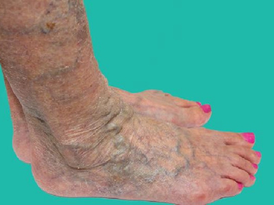 jpg 原发性大隐静脉曲张脚上血管凸出明显图.jpg