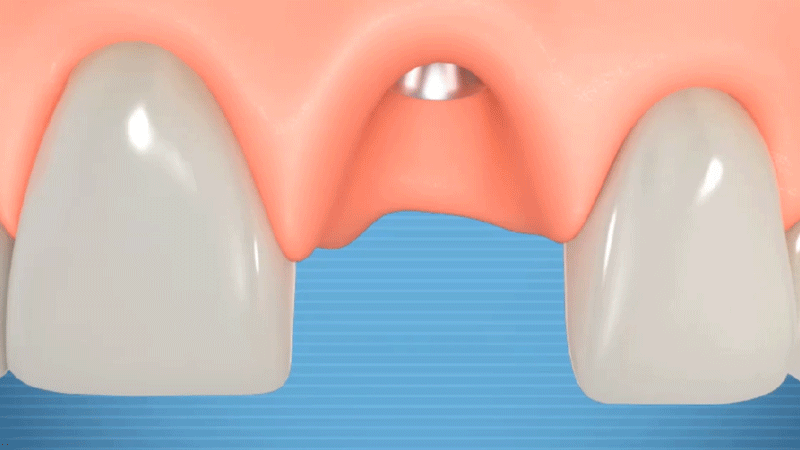 gif 固定义齿-2.gif