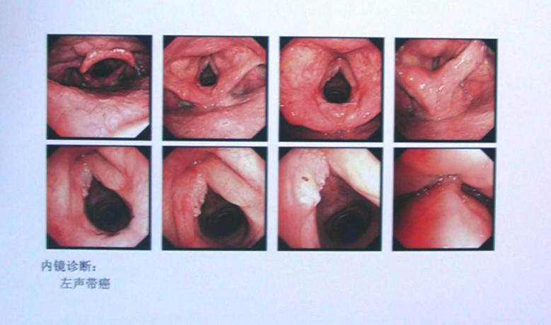 图1纤维喉镜检查:左声带肿物图像