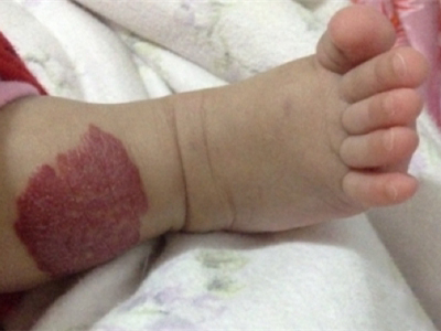 jpg 蔓状血管瘤小腿上有一大块深红色肿块图.jpg