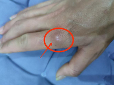 jpg 皮肤钙质沉着症手指关节处白色疙瘩图.jpg