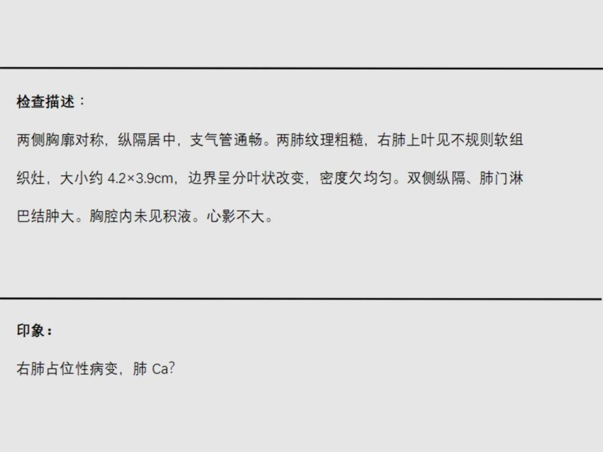 png 肺鳞癌(男子患肺鳞癌,全身化疗+放疗可延缓病情发展!).png