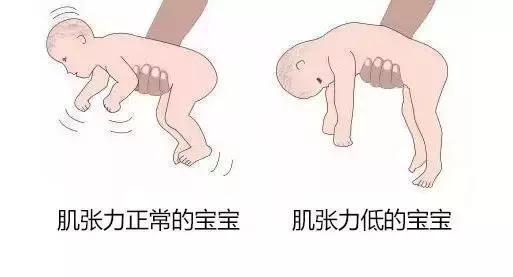 肌张力高低.jpeg