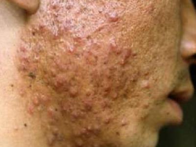 jpeg 面部痤疮图片.jpeg