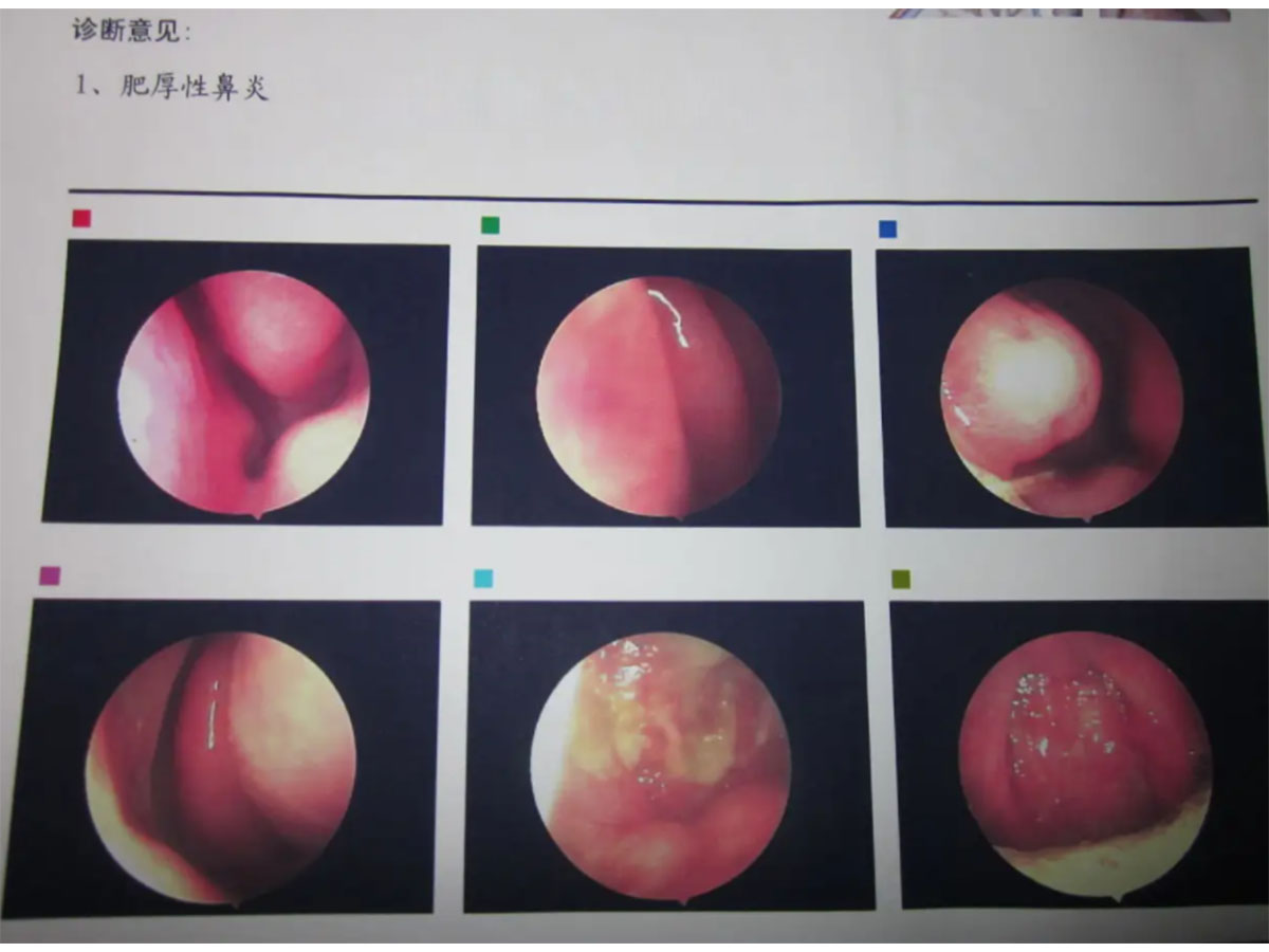 png 鼻甲肥大.png