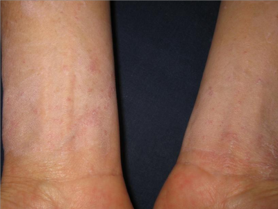 png 疱疹型癣菌疹胳膊上有很多小红点图.png