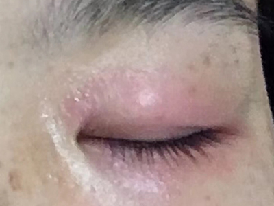 接触性睑皮炎症状图片