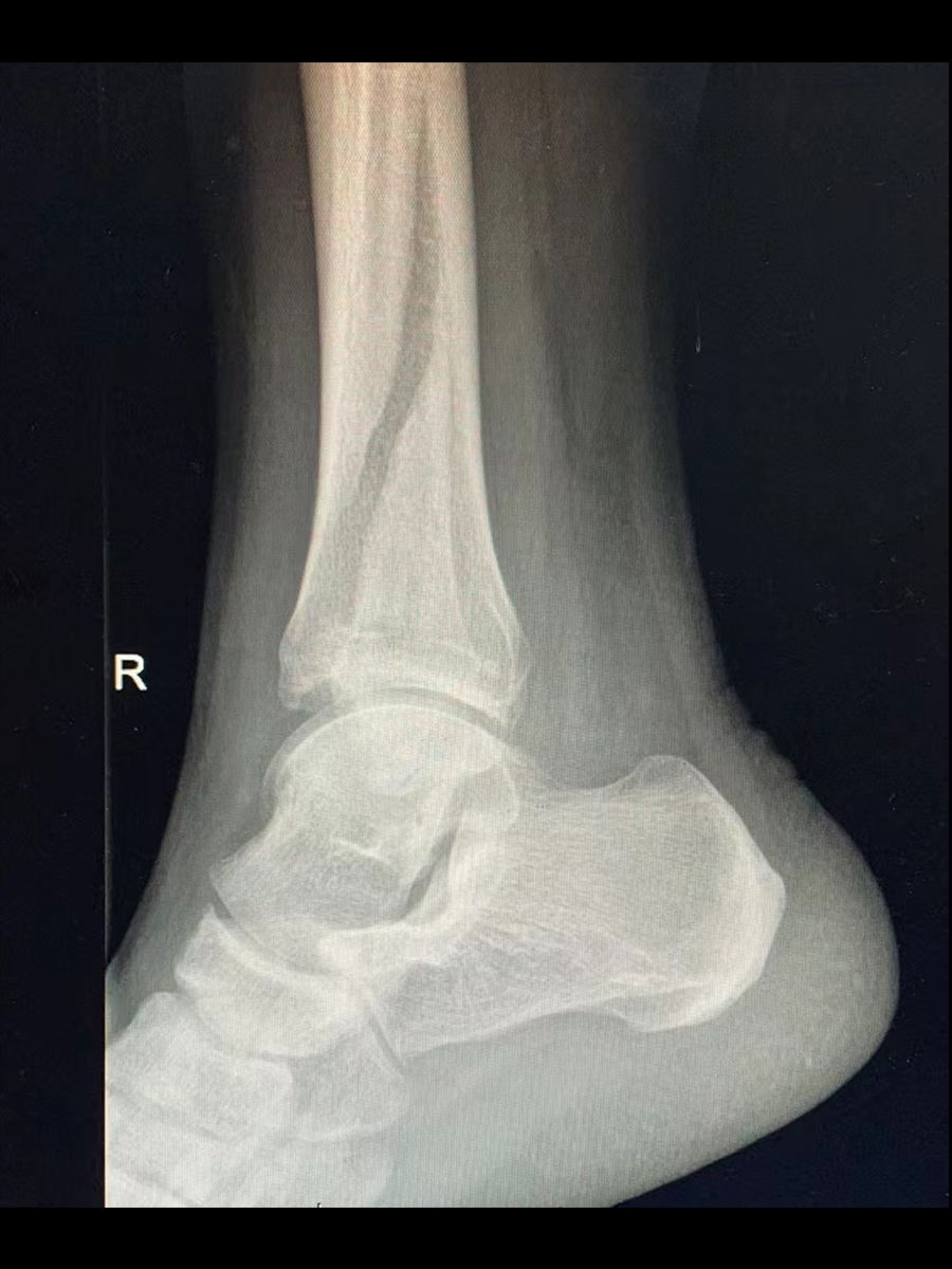 腓骨骨折02.jpg
