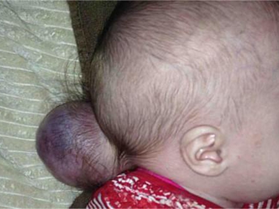 jpg 显性颅裂头部有个大的包块图.jpg