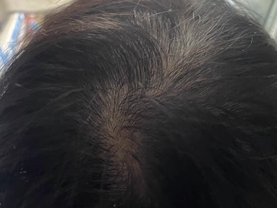 jpg 女性型脱发头顶发缝头发稀疏图.jpg