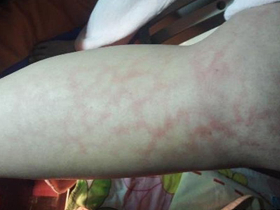 jpg 共济失调毛细血管扩张症腿部红血丝图.jpg