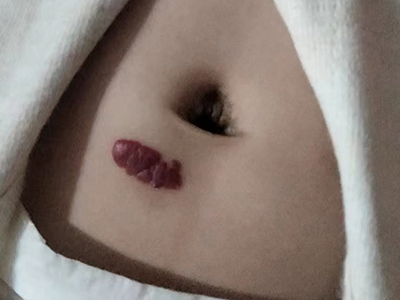 jpg 浅表型婴儿血管瘤肚子上有鲜红色斑块图.jpg