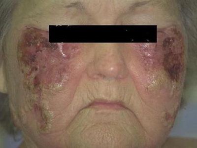 jpg 皮肤白血病脸上长紫红色斑烂了图.jpg