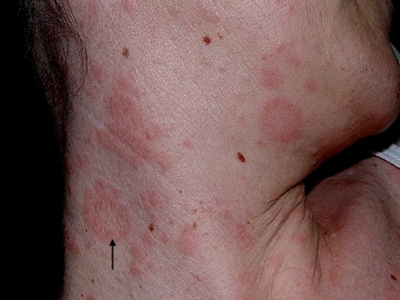 jpg 体癣侧颈部有很多圆环形红色斑片图.jpg