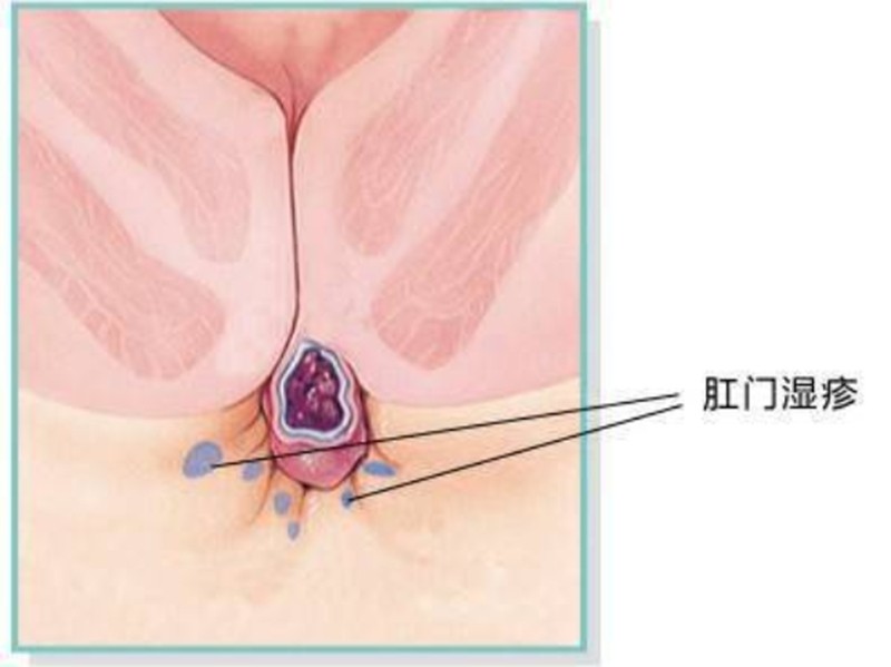 成人肛門(mén)濕疹圖片