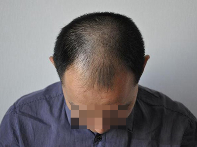 雄激素性脱发症状图片