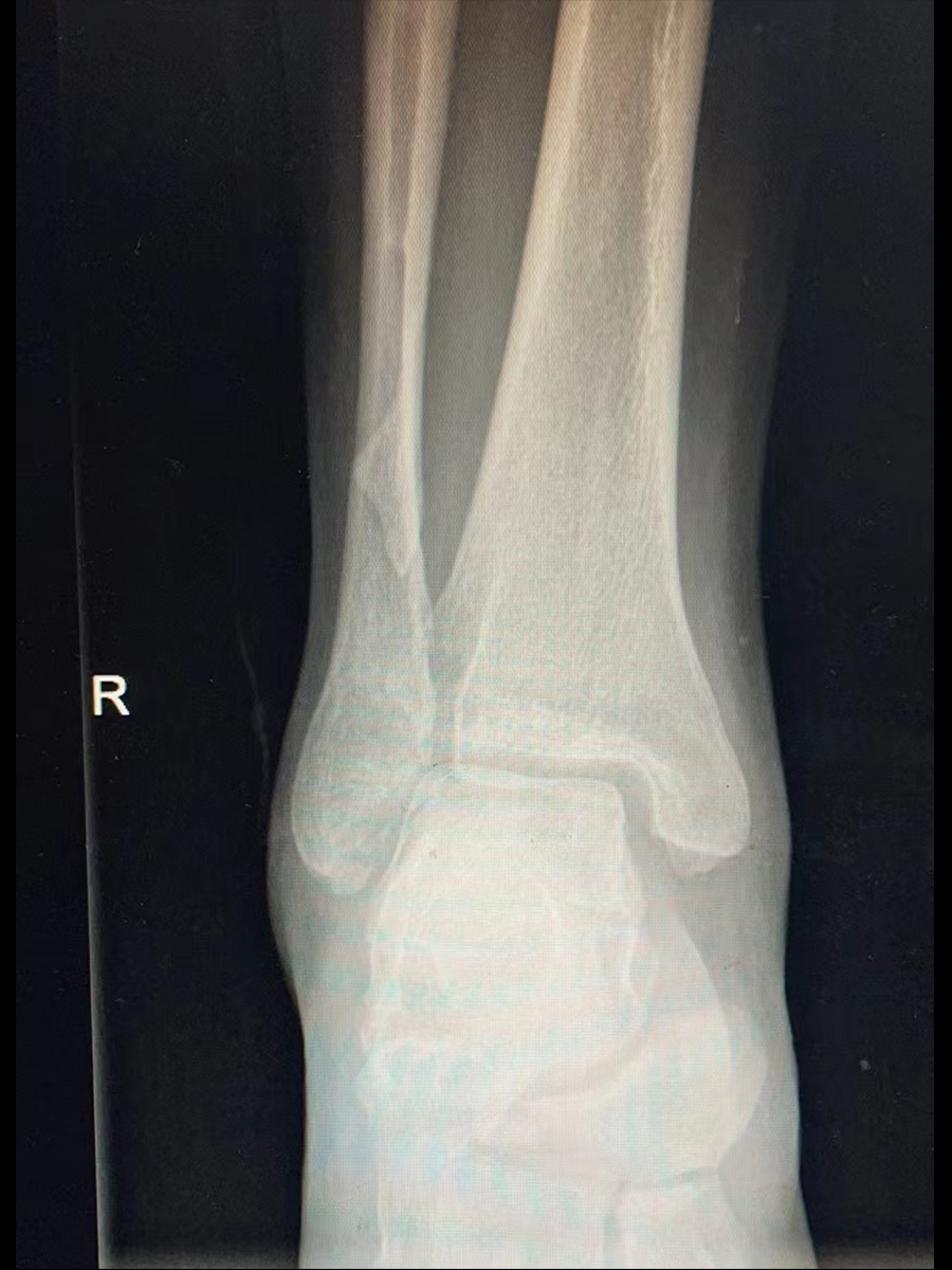 腓骨骨折01.jpg