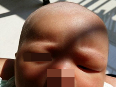 jpg 皮下血肿左额和眼周肿胀图.jpg