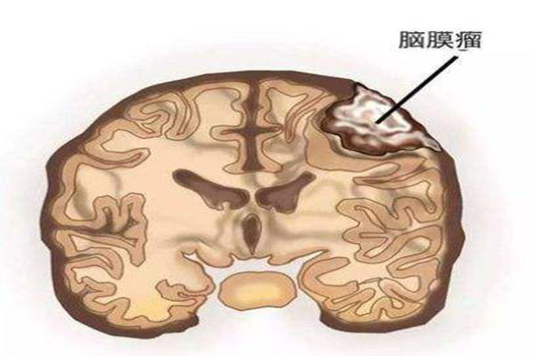 脑肿瘤2.jpg