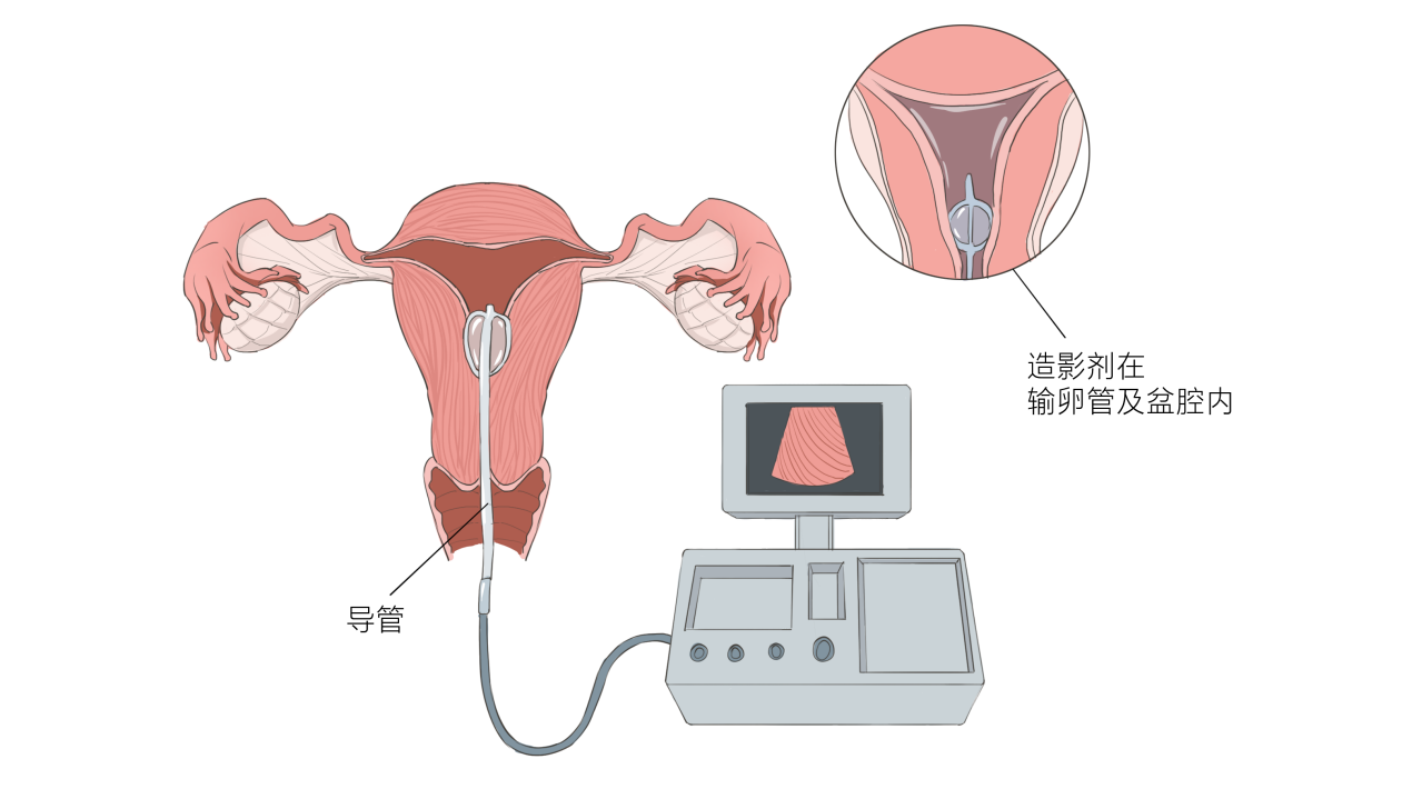 子宫输卵管造影步骤大揭秘