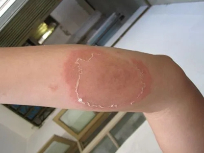 jpg 急性一氧化碳中毒胳膊红斑脱皮图.jpg