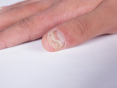 jpeg 指甲萎缩大拇指指甲不规则变薄图.jpeg