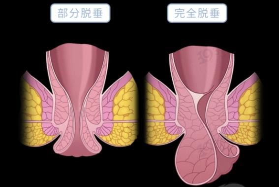 脫肛圖片 (41)