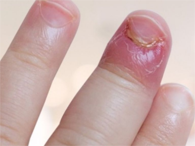 png 脓性指头炎手指头红肿流脓图.png