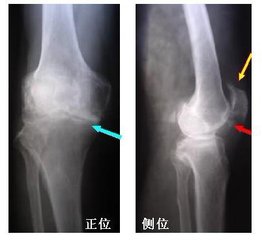 膝盖滑膜炎的治疗方案 AC71ECBAA2C62D5B714CD76165C4390C.jpeg