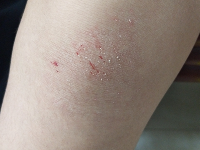 jpg 跌伤膝盖瘀斑上有白色皮屑和红色裂口图.jpg